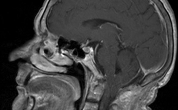 Malformazione di Chiari