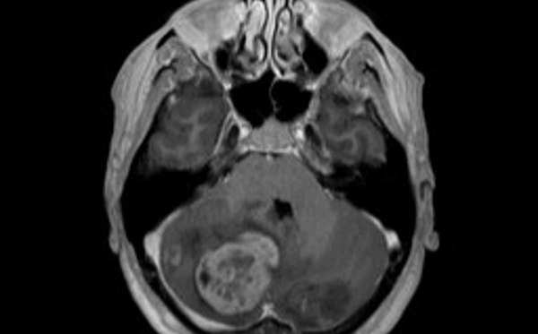 Medulloblastoma