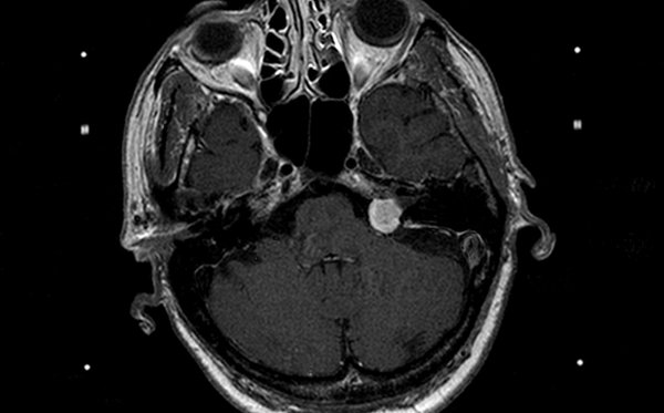 Neurinoma dell'acustico