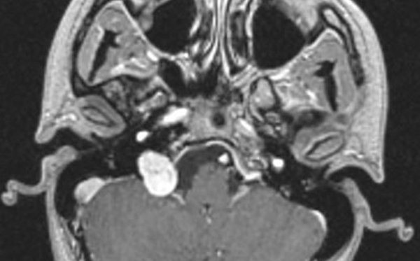 Neurinoma intracranico